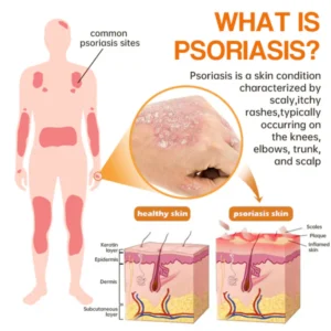 LOVILDS™PsoriaHeal psoriasis Spray pro