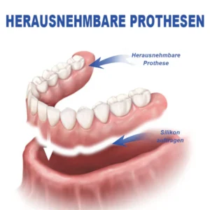 Seurico™ Thermoplastischer Prothesenkleber