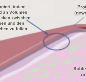 Seurico™ Thermoplastischer Prothesenkleber