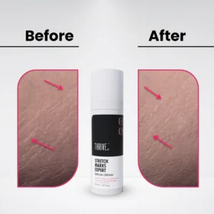 Stretch Marks Expert, Serum Cream