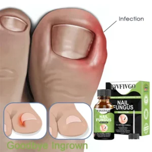 Fivfivgo™ FootCure Gel for the removal of paronychia