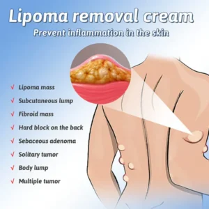 QB™ Herbal Lipoma Removal Cream