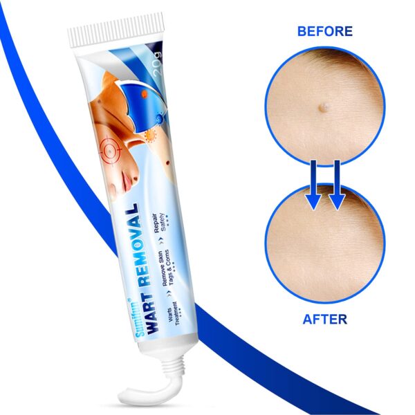 Reclaim Confidence with Our Powerful Skin Tag Remover Cream