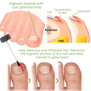 Fivfivgo™ FootCure Gel for the removal of paronychia