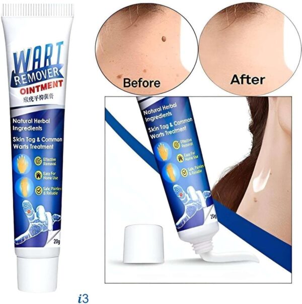 Wart Remover – Say Goodbye to Warts and Moles for Smooth, Healthy Skin