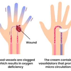 Diabetic Wounds Treatment Cream