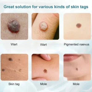 HZA™ Concentrated potent skin tag removal cream