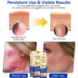 LOVILDS™ PsoriaHeal Bee poison Psoriasis Treatment Spray pro