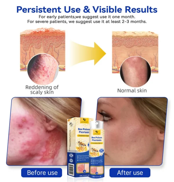 LOVILDS™ PsoriaHeal Bee poison Psoriasis Treatment Spray pro