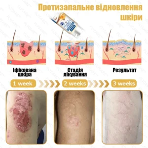 Professional remedy for psoriasis on the body