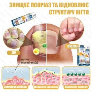 Professional remedy for psoriasis on the body