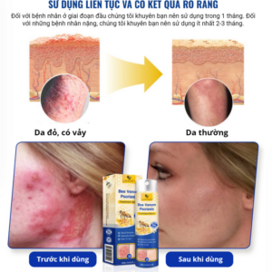 LOVILDS™ PsoriaHeal pro spray for psoriasis and eczema