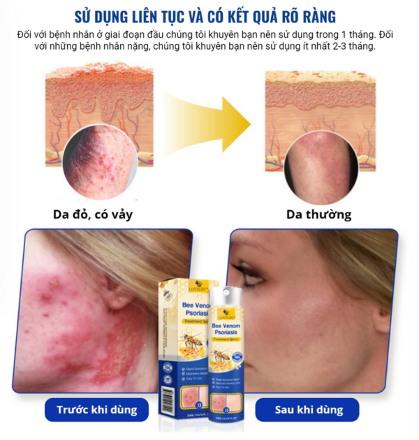 LOVILDS™ PsoriaHeal pro spray for psoriasis and eczema