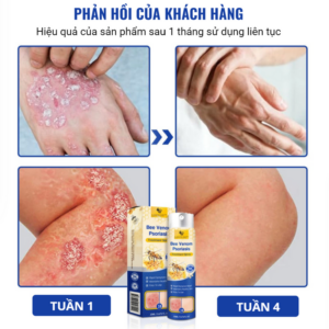 LOVILDS™ PsoriaHeal pro spray for psoriasis and eczema