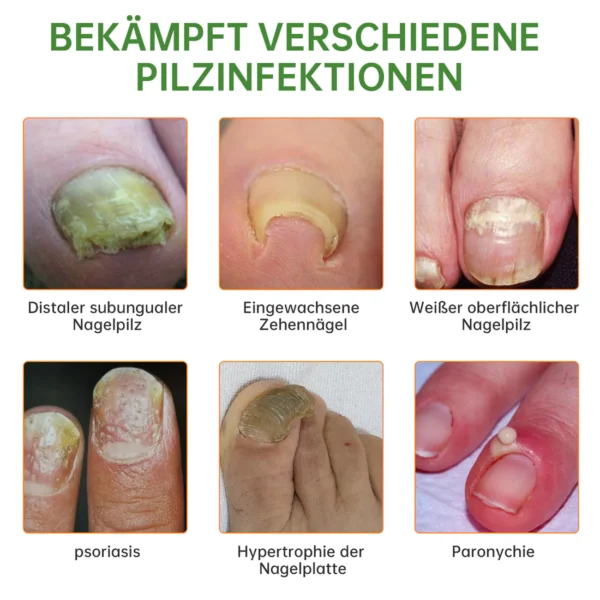 Dobshow™ Bienengift Nagelpilz-Behandlung Liquid