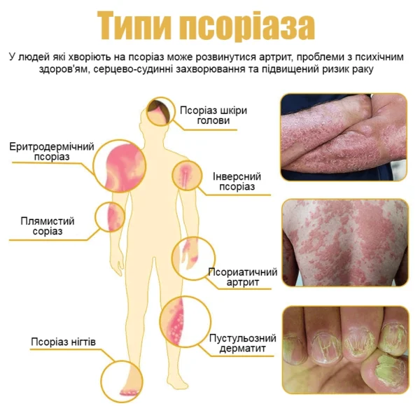 Professional remedy for psoriasis on the body