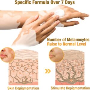 Fivfivgo™ BeeVenom Vitiligo