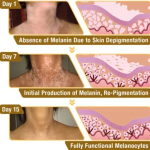 Fivfivgo™ BeeVenom Vitiligo